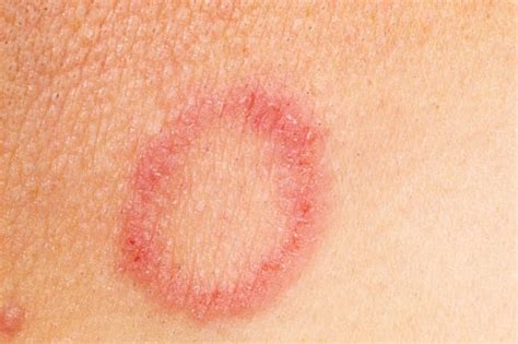 Ringworm In Babies And Children Treatment And Prevention