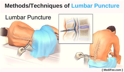 Lumbar Puncture Methods Complications And Recovery 2023