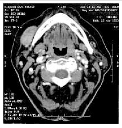 Axial Contrast Enhanced Ct Scan Demonstrated A Solid Download