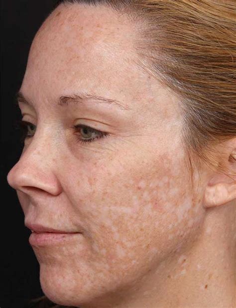 Pigmentation Therapy And Skin Brightening Umhlanga And Ballito Durban