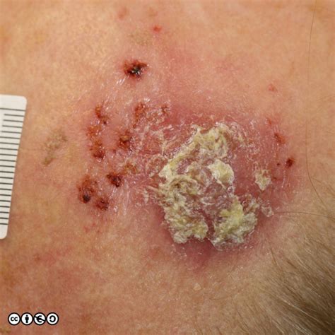 Premalignant Lesions Skin Cancer 909