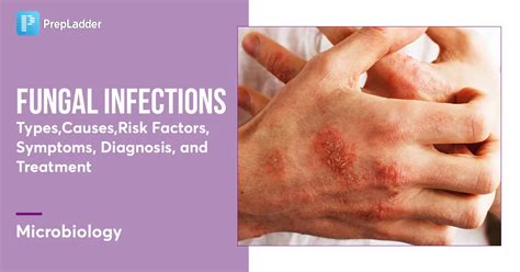 Fungal Infections Types Causes Risk Factors Symptoms Diagnosis