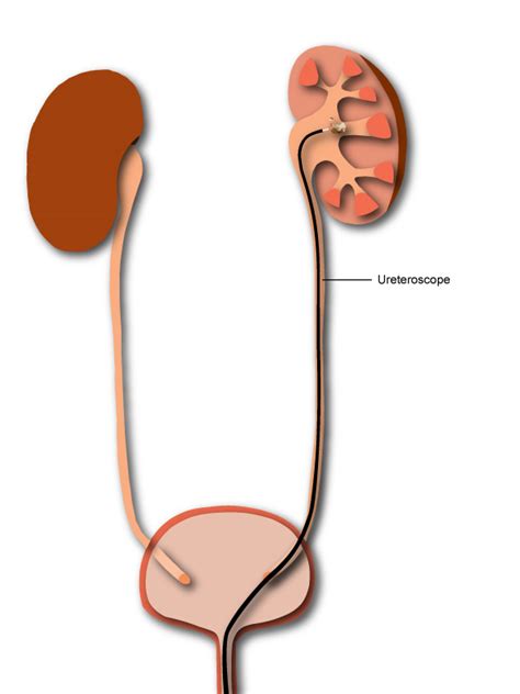 Ureteroscopy For Kidney Stones Laser Lithotripsy