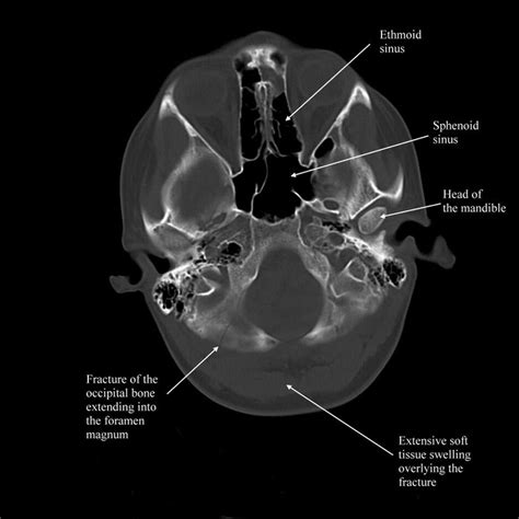 Occipital Bone Fracture Radiology Radiography Bone Fracture