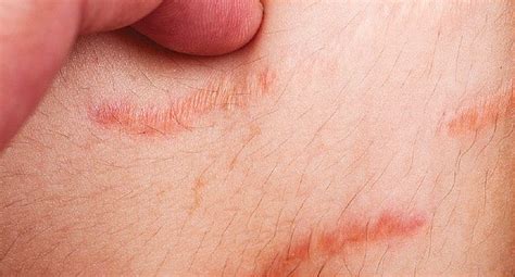 Stretch Marks Causes And Treatments Health And Beauty Tips