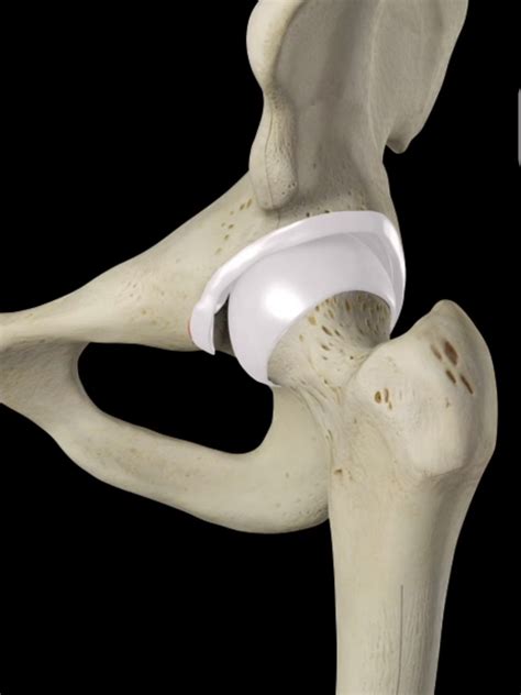 Hip Replacement Surgery Melbourne Pjs Orthopaedics