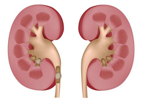 Kidney Stones Are On The Rise Renavive Natural Kidney Cleanse