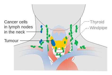 Posted in anatomy, body parts | tagged anatomy of neck, human neck, neck anatomy, neck chart, neck diagram, neck diagram with labels, neck explained, where is neck. File:Diagram showing stage N1b thyroid cancer CRUK 243.svg ...