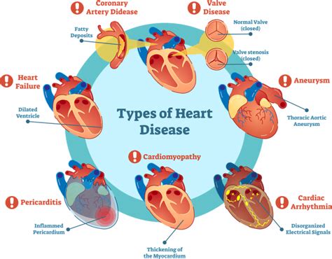 The Signs And Types Of Cardiovascular Disease Edta Chelation Uk