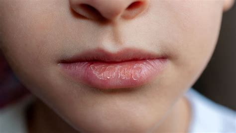 How To Get Rid Of Red Ring Around Lips Overnight Quick And Effective