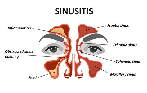 Acute Sinusitis Allied Ent
