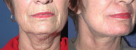 Best Procedure For Neck Tightening 2020 Canada Beryl Muller