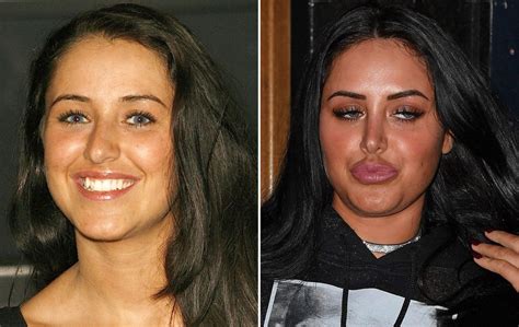 Celebrity Lip Fillers Before And After Ok Magazine