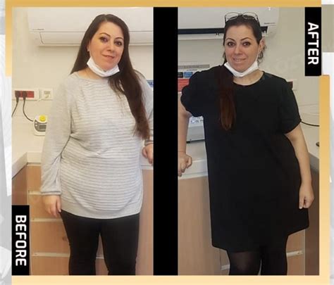 tube gastric bypass ester clinic istanbul