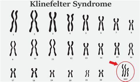 Klinefelter Syndrome Diagram Flowcharts