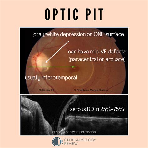 Optic Pit — Ophthalmology Review