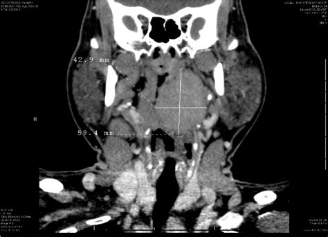 Ct Scan Neck With Contrast Coronal Cut Well Defined Elongated Spindle