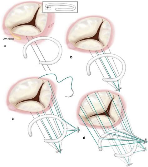 Tricuspid Ring Annuloplasty For Functional Tricuspid Regurgitation