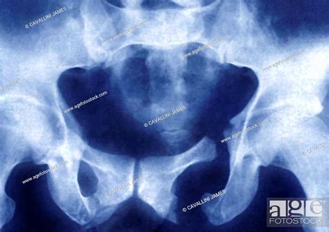 Fractured Pelvis X Ray Fracture Of The Pelvis X Ray Of The Pelvis In