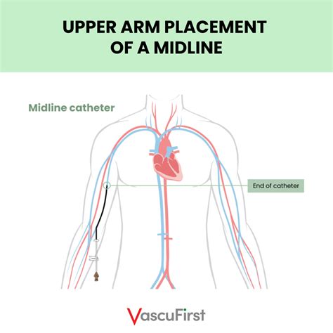 Peripherally Inserted Central Catheters Piccs The Key Principles