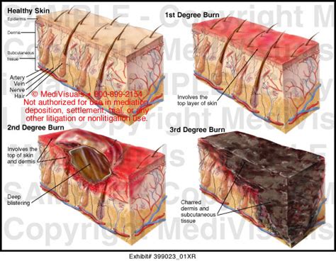 Depth Of Burn Injury Medical Illustration Medivisuals