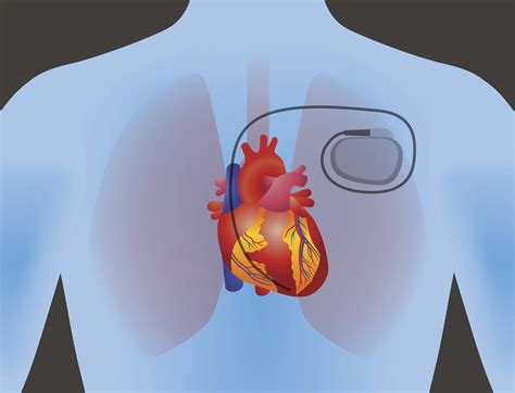 Pacemaker Implantation Waco Cardiology Associates