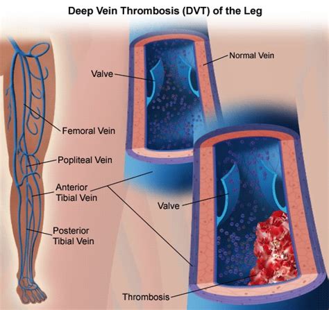 Deep Venous Thrombosis Dvt Glendale Heart Institute Cardiology
