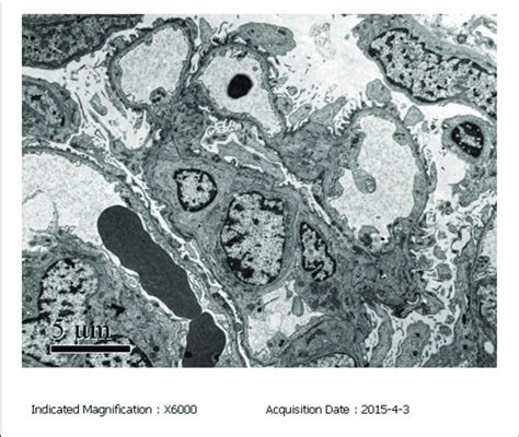 Electron Microscopy Em Of The Kidney Biopsy Specimen The Mesangial