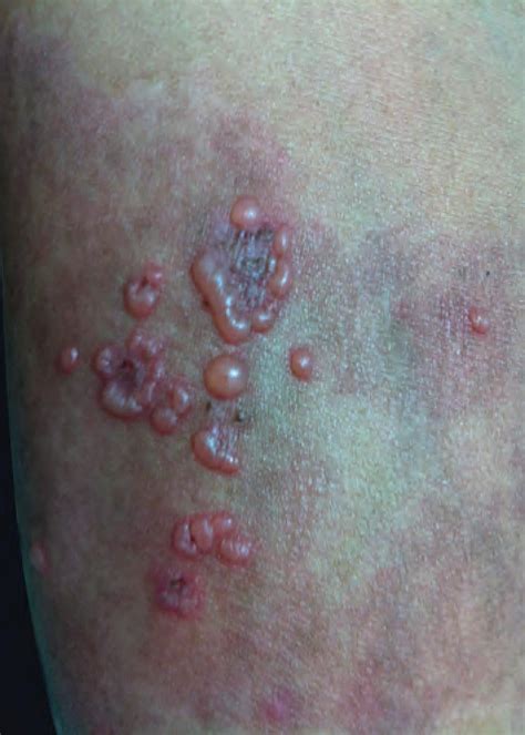 Scielo Brasil Adult Linear Iga Bullous Dermatosis Report Of Three
