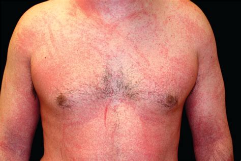 Diffuse Pruritic Papular Rash Aafp