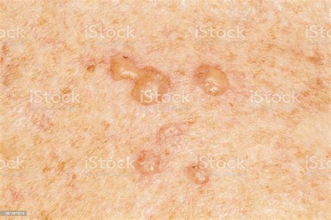 Blisters On Human Skin Rm Stock Photo Download Image Now Bacterium
