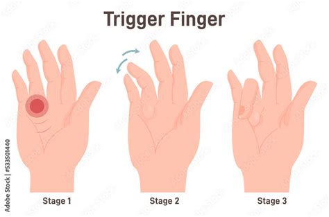 Trigger Finger Or Finger Lock Disease Causing Pain Stiffness And A