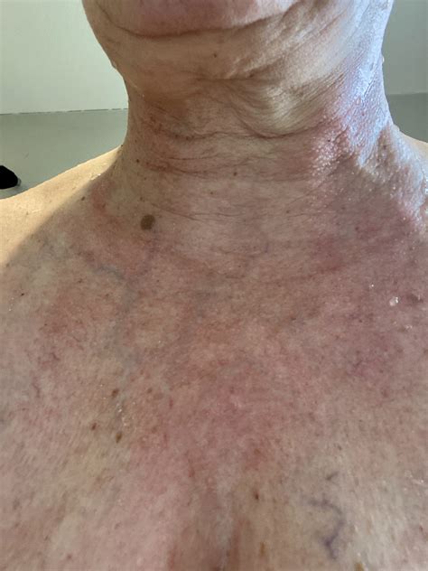 Neck And Exposed Chest Eczema