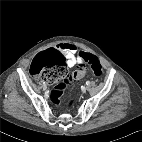 Axial Ct Image Of The Sigmoid Colon In A Patient With Symptoms Of Lbo