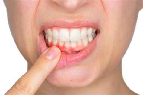 5 Reasons Why You Shouldnt Ignore Gum Disease In Friendswood