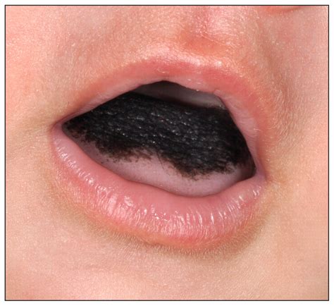 Black Hairy Tongue In An Infant Cmaj