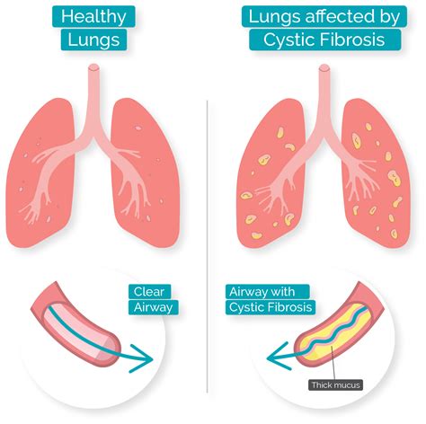 Cystic Fibrosis Life Expectancy Chart