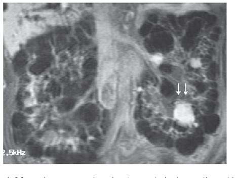 Figure 1 From Erythropoietin Production In Renal Cell Carcinoma And