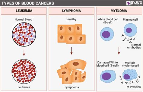 Blood Cancer Types Symptoms Causes And Its Treatment