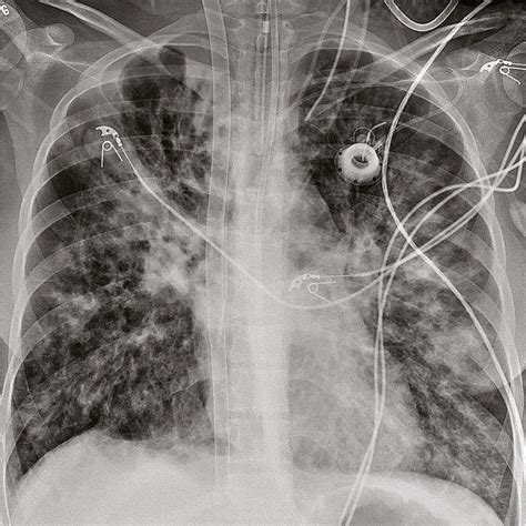 X Ray Showing The Avalon Dual Lumen Ecmo Cannula After Insertion