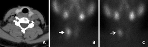 A Non Enhanced Axial Ct Scan Through The Thyroid Gland Shows