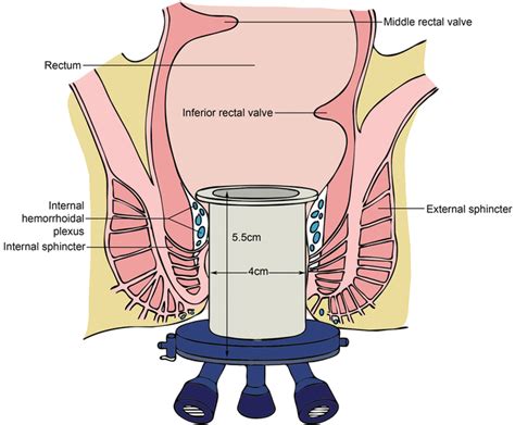 Transanal Minimally Invasive Surgery For Rectal Cancer Abdominal Key