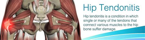 Hip Tendonitiscausessymptomstreatmentexerciseprevention