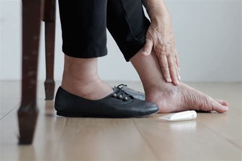 Stopa cukrzycowa groźne powikłanie cukrzycy Jak dbać o stopy przy