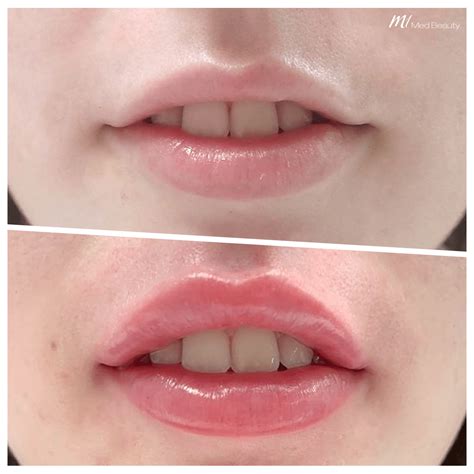 Lip Enhancement With Lip Fillers M1 Med Beauty Australia