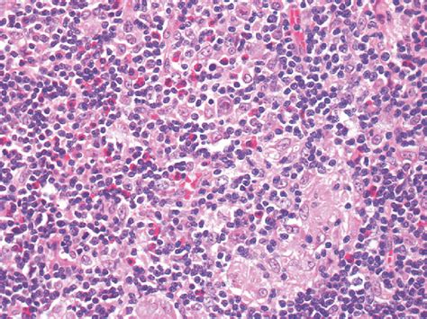 1 This Photomicrograph Shows A Case Of Hiv Related Hodgkin Lymphoma In