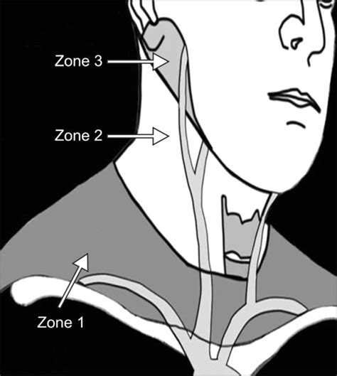 Zones Of The Neck For Classification Of Penetrating Injuries Zone I