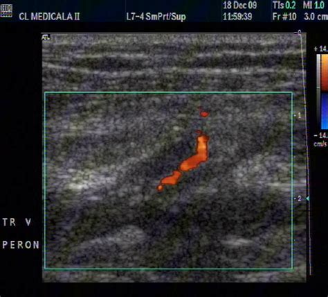 Thrombosis Of Peroneal Vein In A Patient With Pc 2d And Colour Doppler