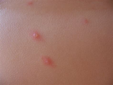 A Rash On The Body With Tiny Blisters In The Middle Of The Rashes On A