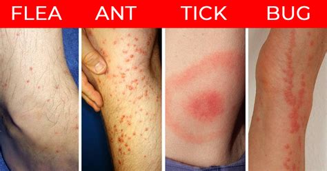 How To Recognize 7 Kinds Of Common Insect Bites Tips And Hacks Handimania